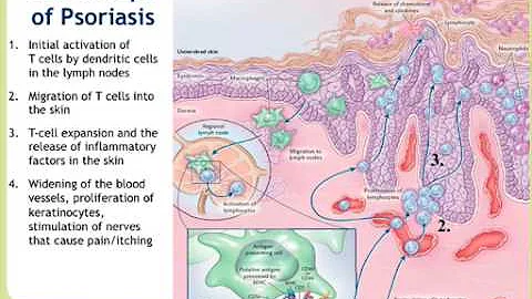 NPF Webinar:  Psoriasis: More Than Skin Deep, Part 1