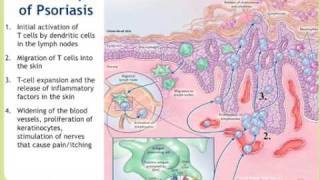 Npf Webinar Psoriasis More Than Skin Deep Part 1