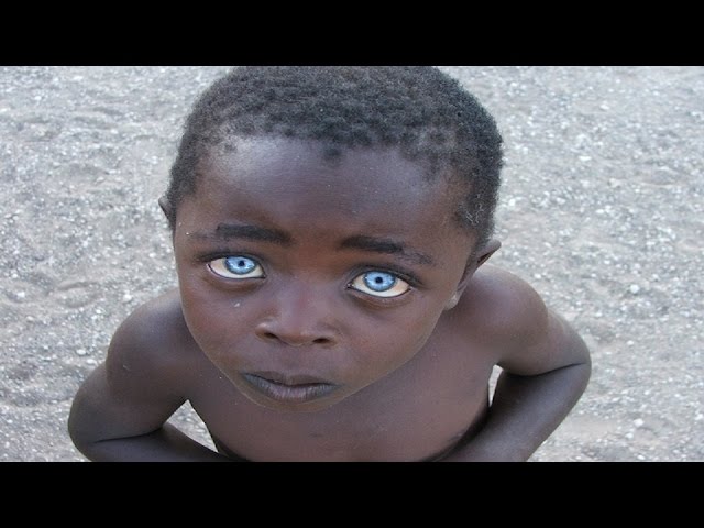 Rare Eyes In The World What Is The Rarest Eye Color In The World?