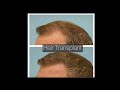 Dallas Hair Transplant Before and After