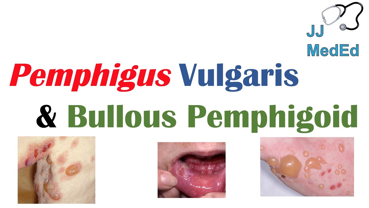 Is Bullous Pemphigoid A Disability?