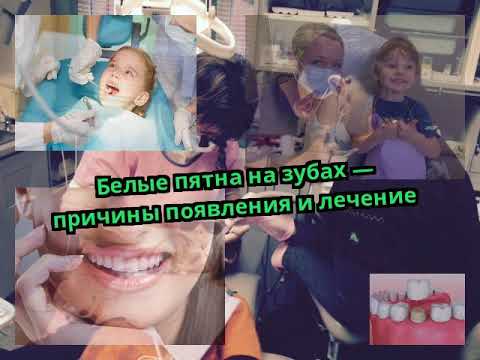 Белые пятна на зубах — причины появления и лечение