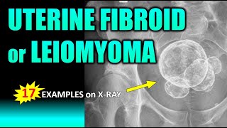 Uterine Fibroid or Leiomyoma #radiology #medical #health