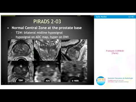 Vidéo: Précision De La Propagation Automatique Des Structures Déformables Pour La Radiothérapie De La Prostate Guidée Par IRM à Haut Champ