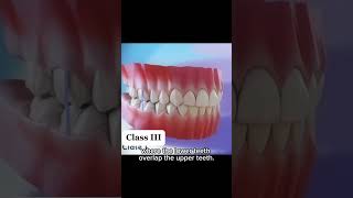 Famous Class III Maloccluson - Explaining Class III Malocclusion in classic, “Dr. Mike” style! Profile