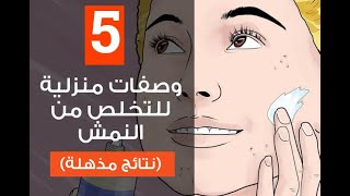 وصفات منزلية للتخلص من النمش (نتائج سريعة ومذهلة)