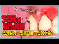 양치질하다 잇몸에 피 났다고요?!!  | 스케일링vs잇몸치료vs잇몸수술 | 잇몸병 치료방법 총정리!