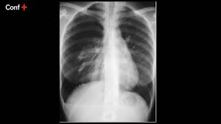 Cas d'imagerie (pneumothorax droit complet)