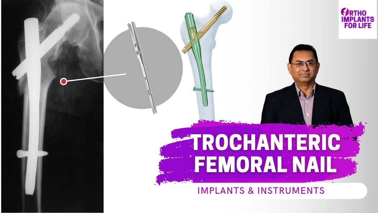 Insertion Handle radiolucent for PFNA Proximal Femoral Nail Orthopedic  Instrument manufacturers and suppliers in China