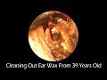 Cleaning Out Ear Wax From 39 Years Old Man With Relaxing Music and Natural Forest