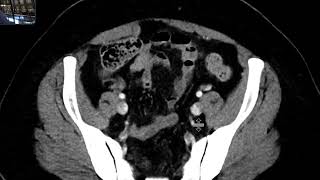 Gastric metastasis