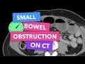 Small bowel obstruction on CT - Radiopaedia