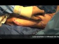 Arm lift Surgery in Utah.  Live plastic surgery video.