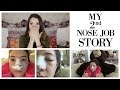 Why I Got Another Nose Job + My Revision Rhinoplasty Story | Blair Fowler