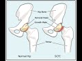 Slipped Capital Femoral Epiphysis (SCFE)