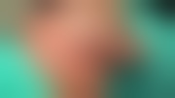 Retro mandibular/trans parotid facial nerve-sparing approach to  fix posterior mandibular fracture