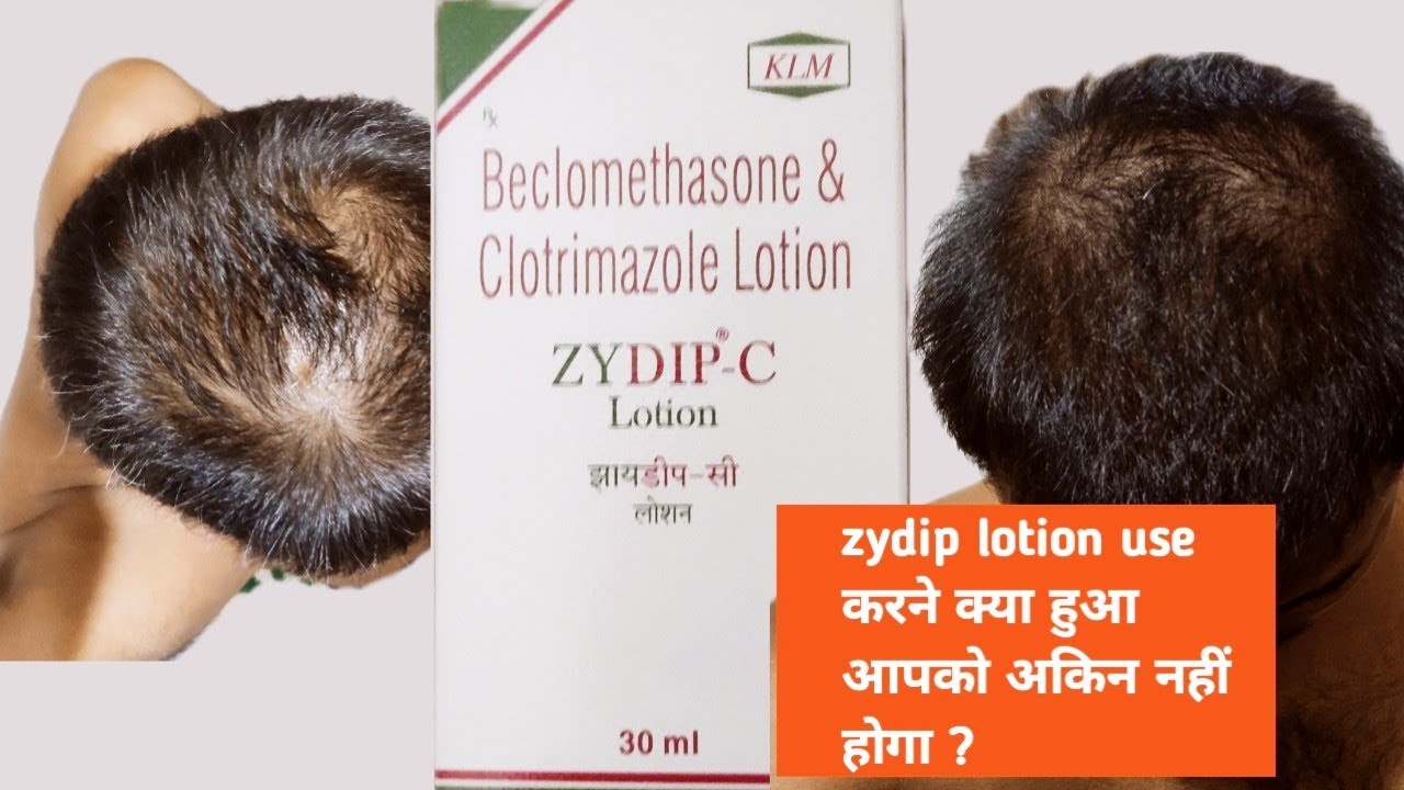 zydip c lotion review in 2022 hindi. beclomethasone & clotrimazole lotion dandruff problem