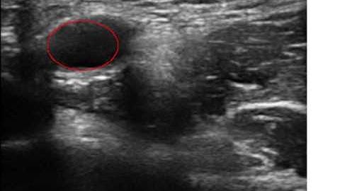 Blood vessel detection in ultrasound images using deep neural networks