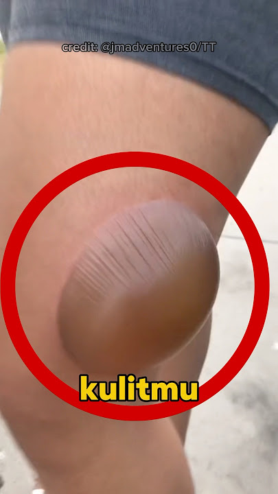 If You Have Blisters on Your Skin, Do This Quickly 😱