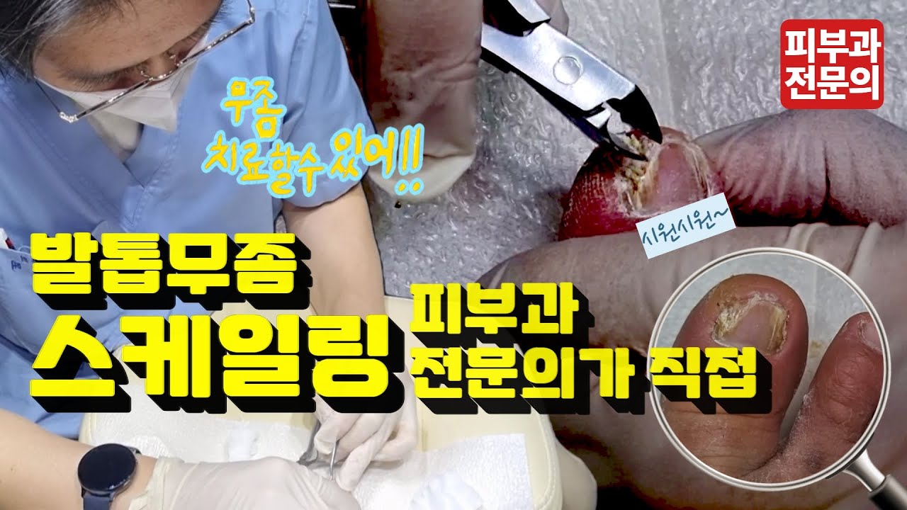 무좀 발톱 스케일링, 피부과전문의가 직접하는 이유는