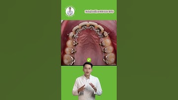 Niềng Răng Bằng Mắc Cài Mặt Trong | Bác Sĩ Tài Tử Tế #bacsitaitute #niengrang