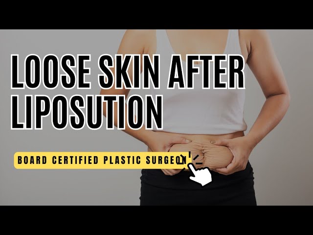 Mini Tummy Tuck: Is It Right for You? - Camille Cash, M.D.