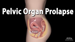 Pelvic Organ Prolapse, Animation