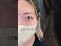 まぶたが腫れぼったい正体は、、？🤔#二重整形 #二重埋没法 #埋没 #二重 #クイックコスメティーク