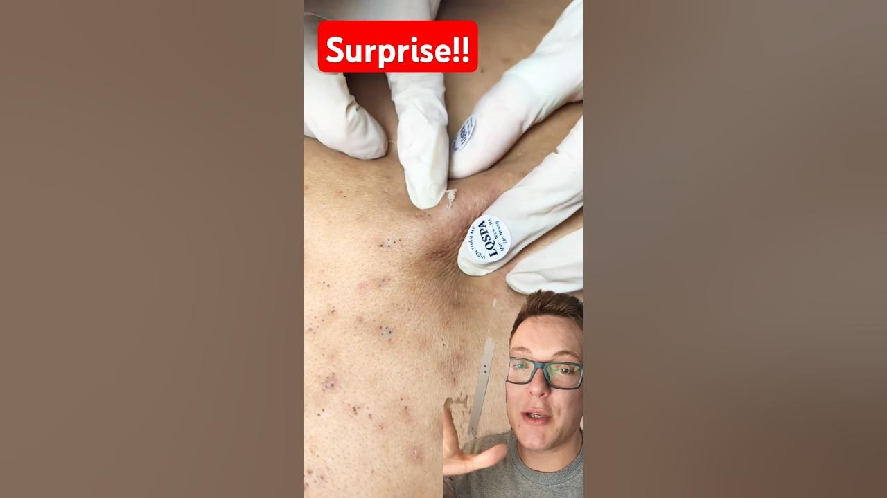 (Shocking) BLACKHEAD REMOVAL Wait For It To Explode shorts YouTube