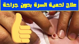 طريقة علاج لحمية السرة بدون جراحة مع فحص المولوده بالسونار