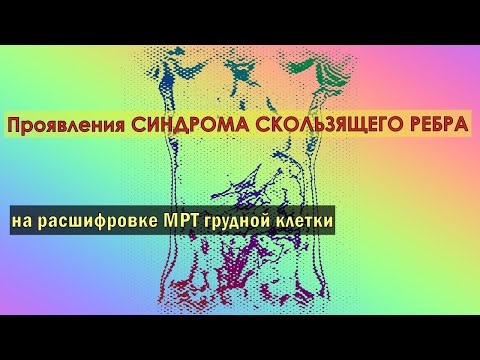 Симптомы проявления СИНДРОМА СКОЛЬЗЯЩЕГО РЕБРА на расшифровке МРТ органов грудной клетки