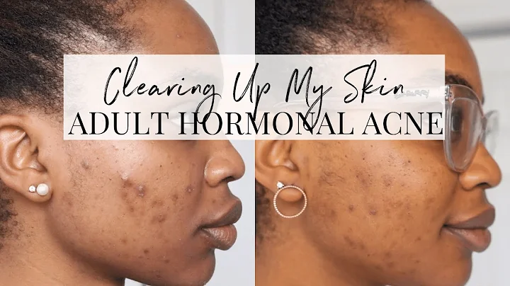 How I Cleared Up Hormonal Acne | SKINCARE UPDATE
