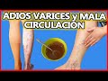 Así Elimine las Varices y la Mala Circulación con Este Remedio Casero