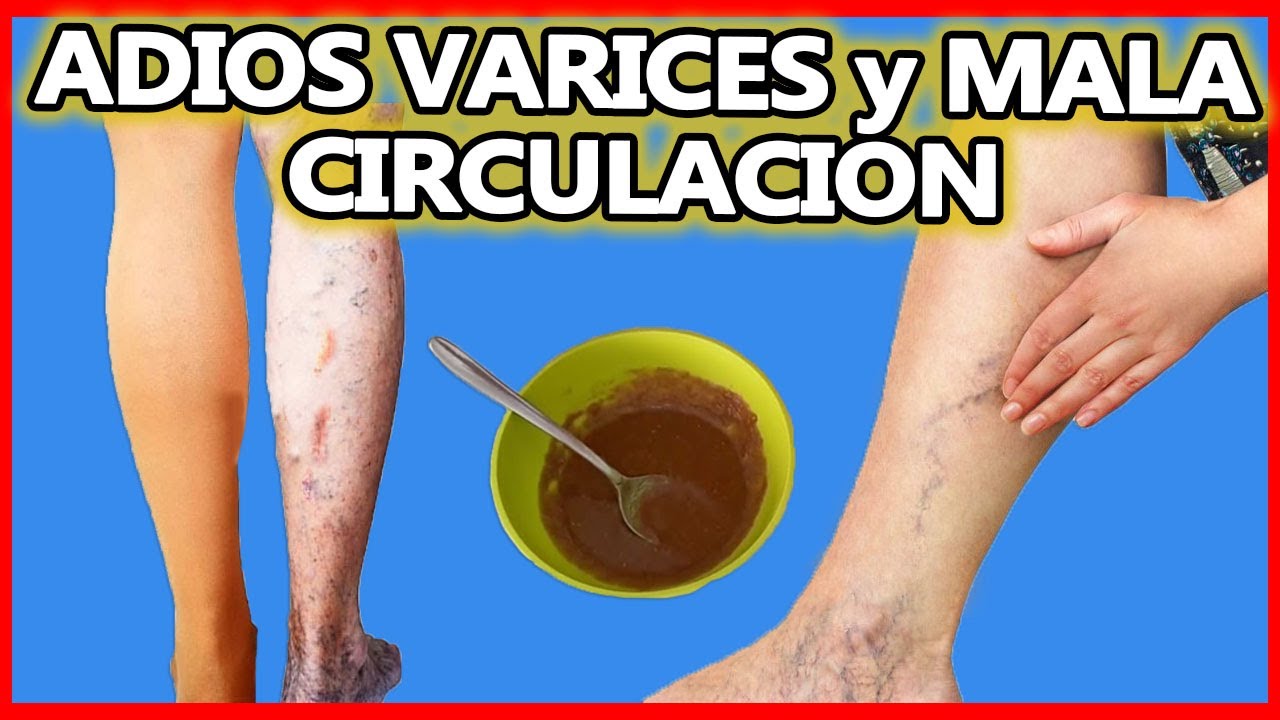 !Muchos No lo Saben! Estos 5 Remedios Curan las Varices Rapidamente. remedios naturales para la artritis