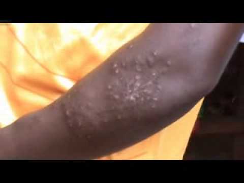 des vers sortent de son corps - YouTube des vers sortent de son corps - YouTube