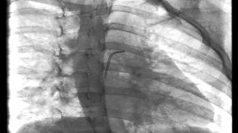 COIL CLOSURE OF TINY PATENT DUCTUS ARTERIOSUS