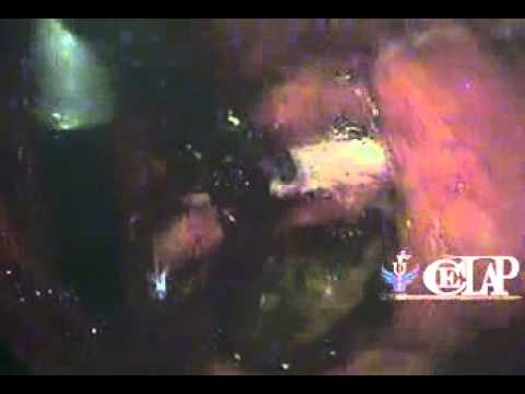 HERNIOPLASTIA INGUINAL DERECHA TEP VIDEOENDOSCOPICA camera iphone 8 plus apk