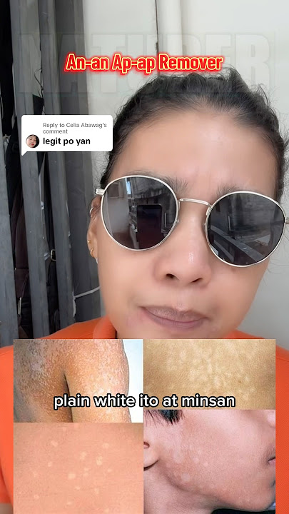 Zudaifu Herbal Cream An-an, Ap-ap, “Tinea Versicolor” Remover #anan #zudaifu #kalahiherbal #naturer