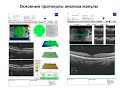 ОКТ в диагностике влажной формы ВМД и ДМО