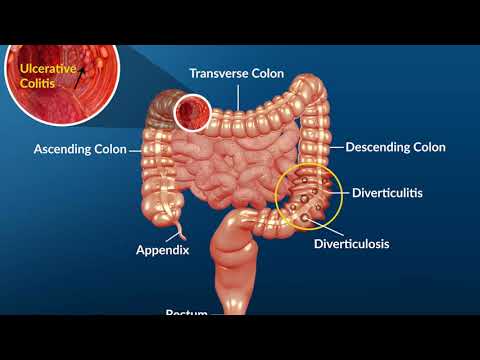 Video: Colita Ulcerativa Si Sarcina: Un Ghid