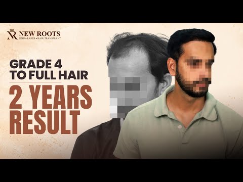 2 Years Later, His Hairline Looks AMAZING! 😍 | Hair Transplant in Kolhapur | New Roots