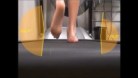 Video gait analysis is used  before custom made orthotics Active Care Podiatry at Capalaba