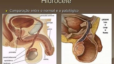 Como eliminar a hidrocele?