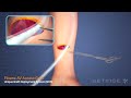 Dialysis access with getinges flixene vascular graft
