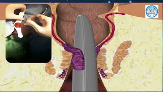 Biolitec lazer cihazı vasitəsi ilə(Babasil) əməliyyatı
