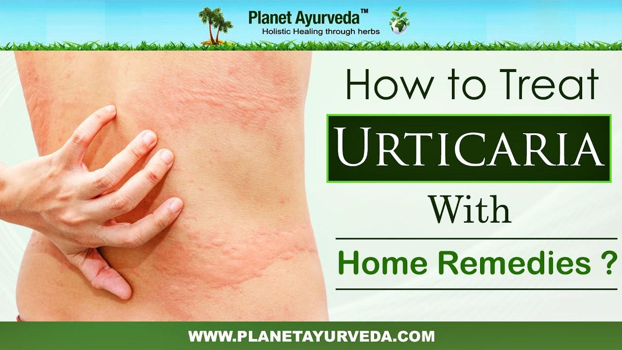 How To Treat Urticaria With Home Remedies Youtube