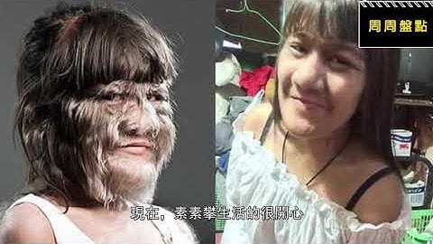 震驚世界，5個天生異類的小孩，罕見的美人魚小孩你見過嗎？【周周盤點】 - 天天要聞
