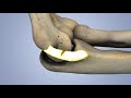 Kinduct  ucl tommy john 3d animation