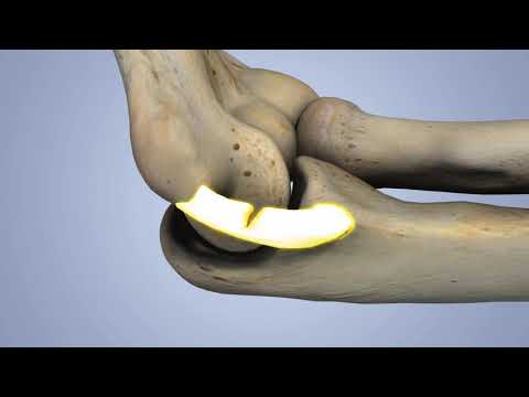 Kinduct - UCL "tommy john" 3D Animation