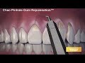 Receding Gums Can Ruin Your Smile - Pinhole Gum Rejuvenation  Is The Answer